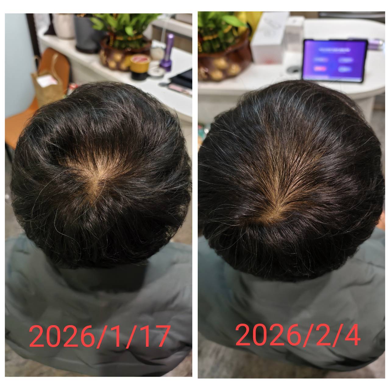 頭皮再生前後對比